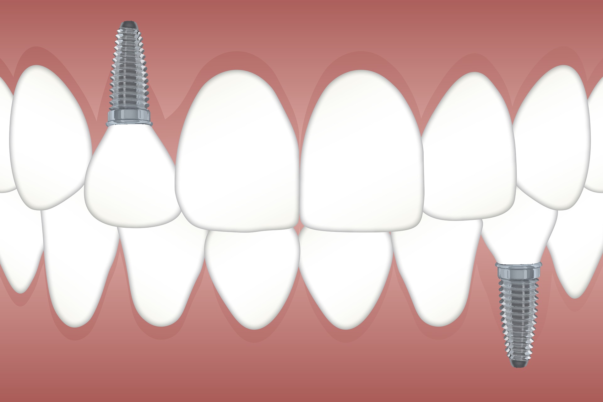 Tooth Extractions vs Dental Implants – What Is Best?
